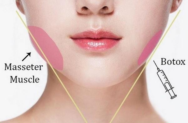 Tiêm Botox hàm: Giải pháp thon gọn khuôn mặt không cần phẫu thuật