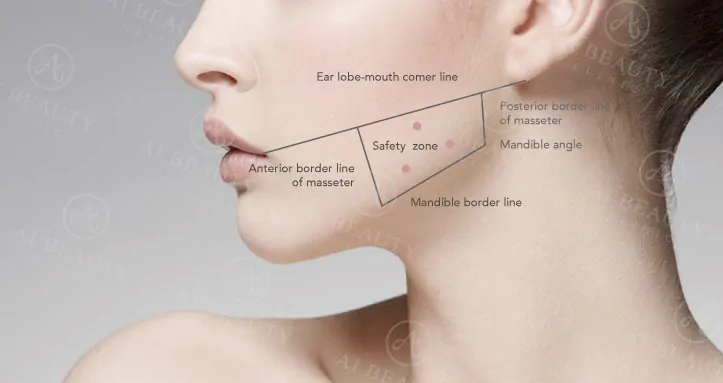 Tiêm Botox hàm: Giải pháp thon gọn khuôn mặt không cần phẫu thuật