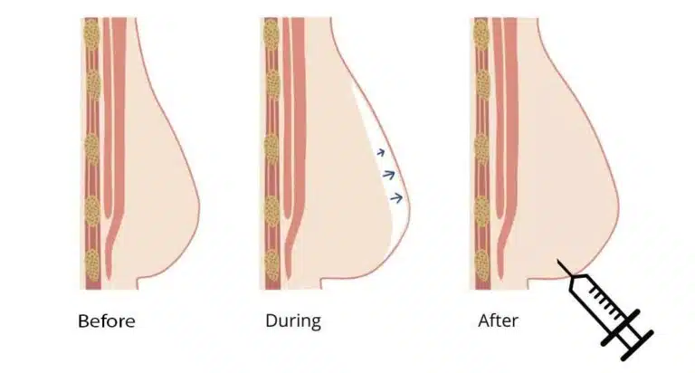 Tiêm túi độn ngực: Giải pháp nâng ngực hiện đại không cần phẫu thuật